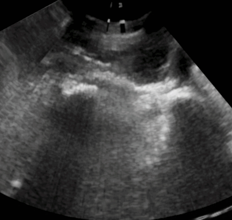 CUS knee scan post-physiotherapy